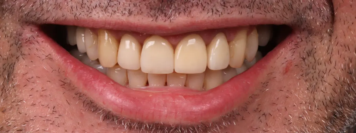 Antes — Lentes de contato dental