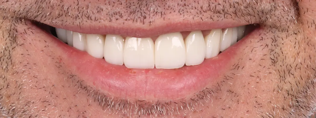 Depois — Lentes de contato dental
