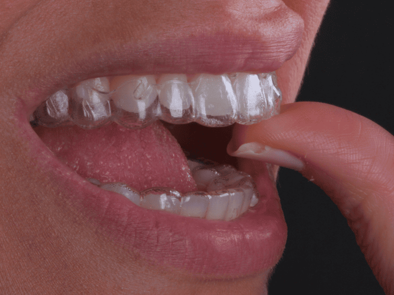 Invisalign