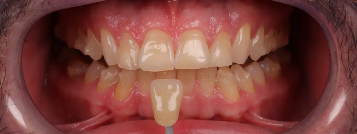 Antes — Clareamento dental