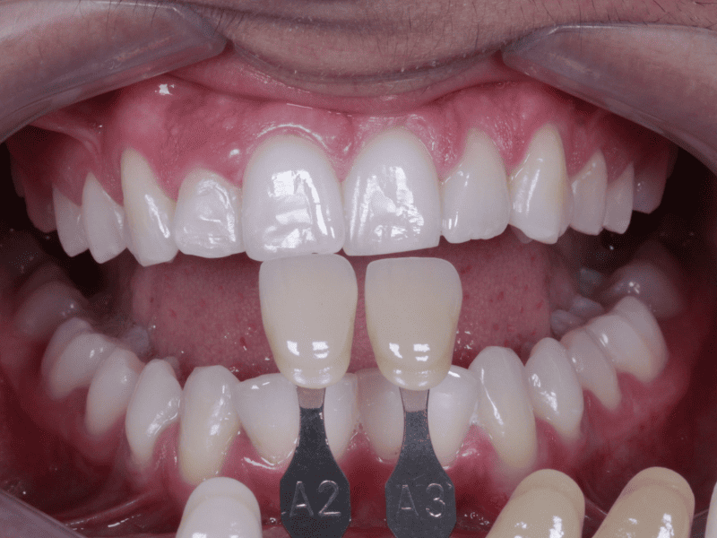 Clareamento dental