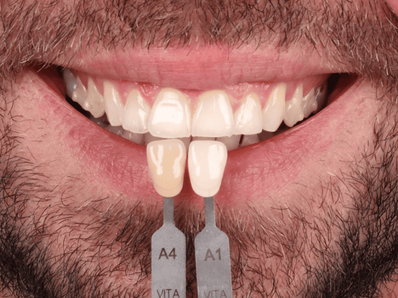 Clareamento dental