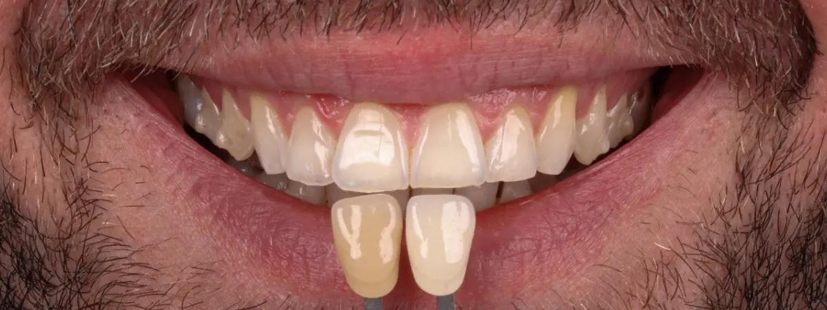 Depois — Clareamento dental