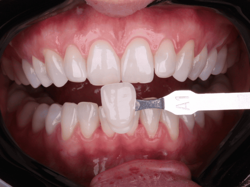 Clareamento dental