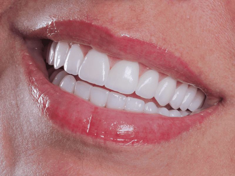 Facetas de porcelana