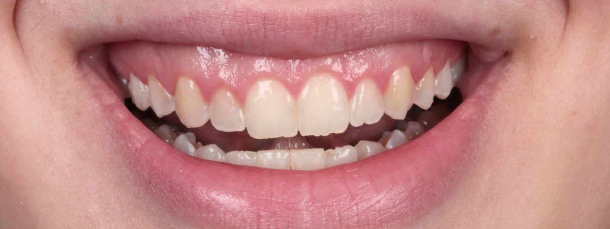 Antes — Gengivoplastia