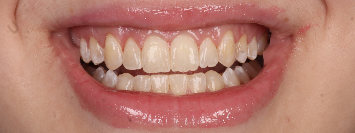 Depois — Gengivoplastia
