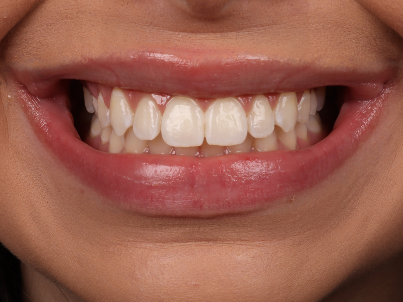 Gengivoplastia