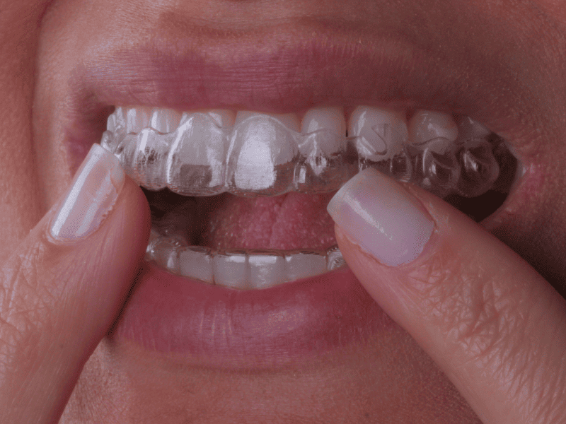 Invisalign