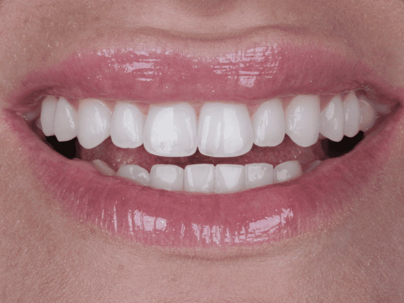 Invisalign