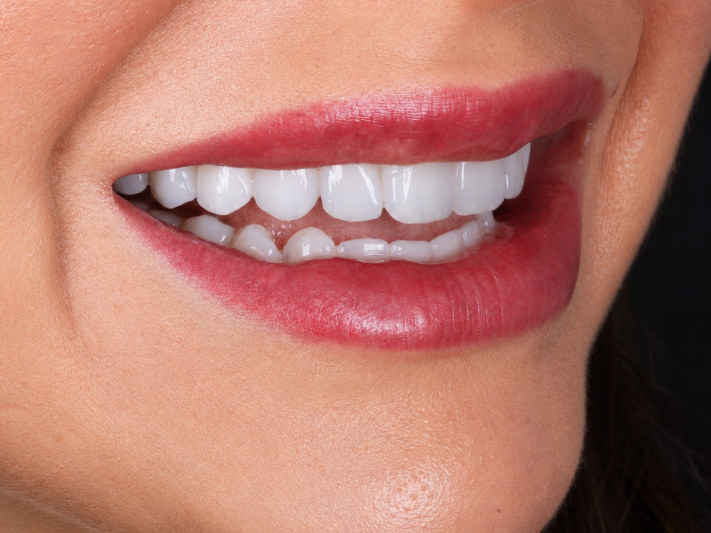 Lentes de contato dental
