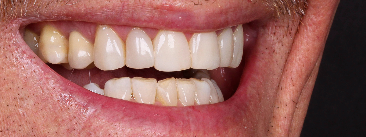 Antes — Lentes de contato dental PJ Odontologia
