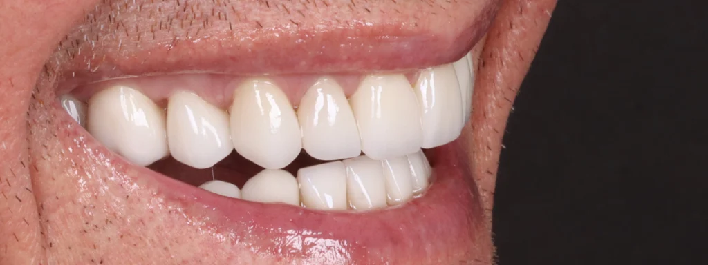 Antes e depois de lentes de contato dental de resina: caso 02, sorriso depois do tratamento