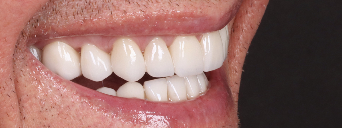 Depois — Lentes de contato dental PJ Odontologia