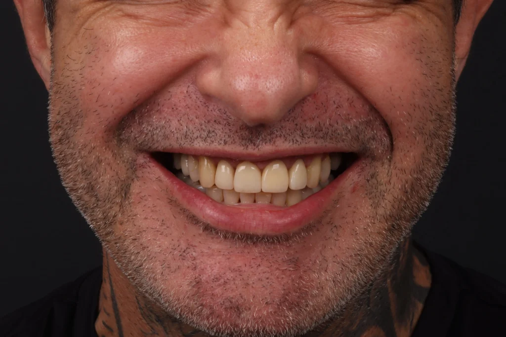Antes e depois de facetas de resina: caso 01, sorriso antes do tratamento