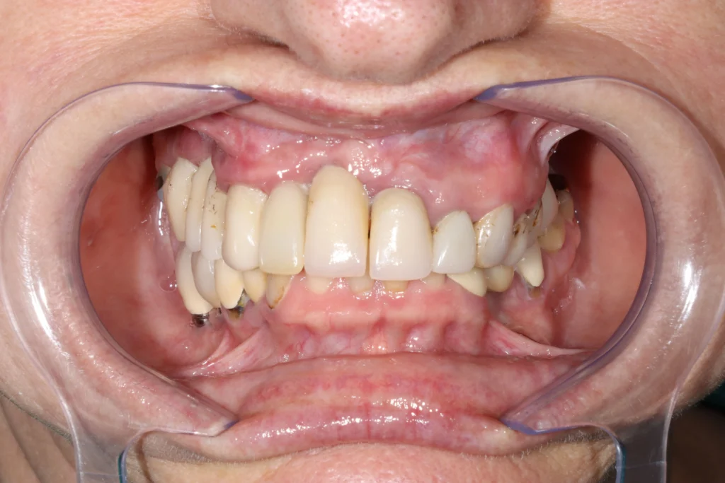 Antes e depois de implante guiado: caso 01, sorriso antes do tratamento