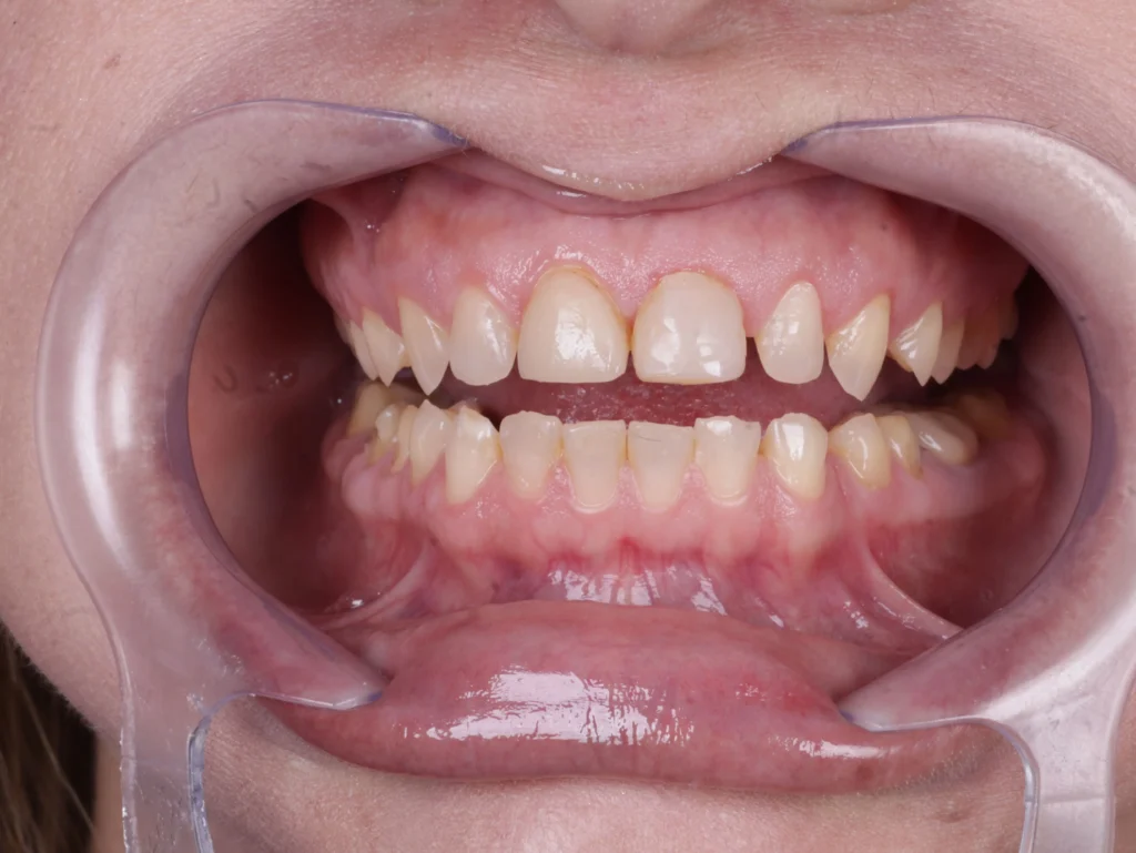 Antes e depois de lentes de contato dental de porcelana: caso 01, sorriso antes do tratamento