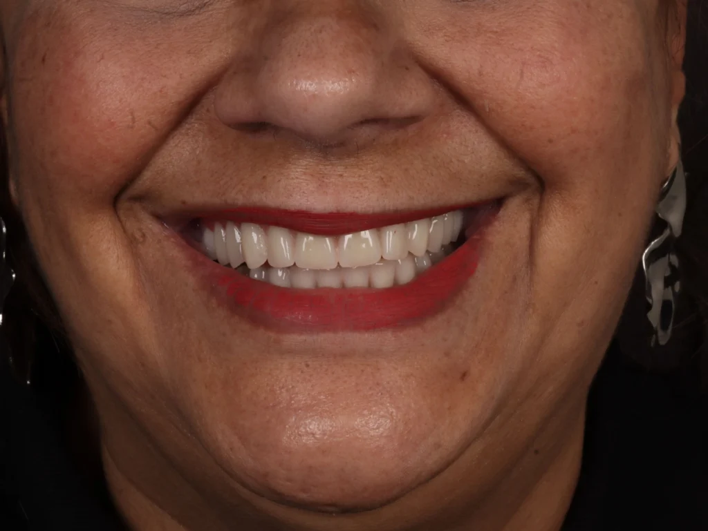 Prótese protocolo: sorriso depois do tratamento, caso 01