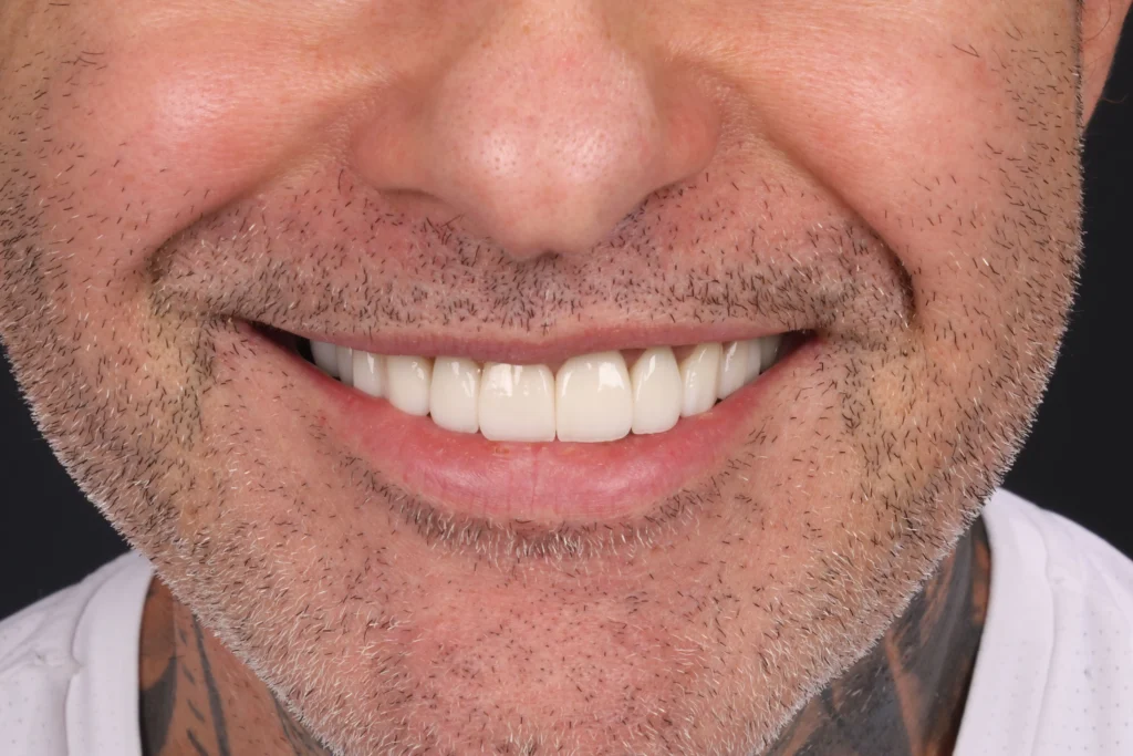 Facetas dentais: sorriso depois do tratamento, caso 01