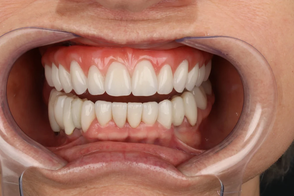 Implante guiado: sorriso depois do tratamento, caso 01