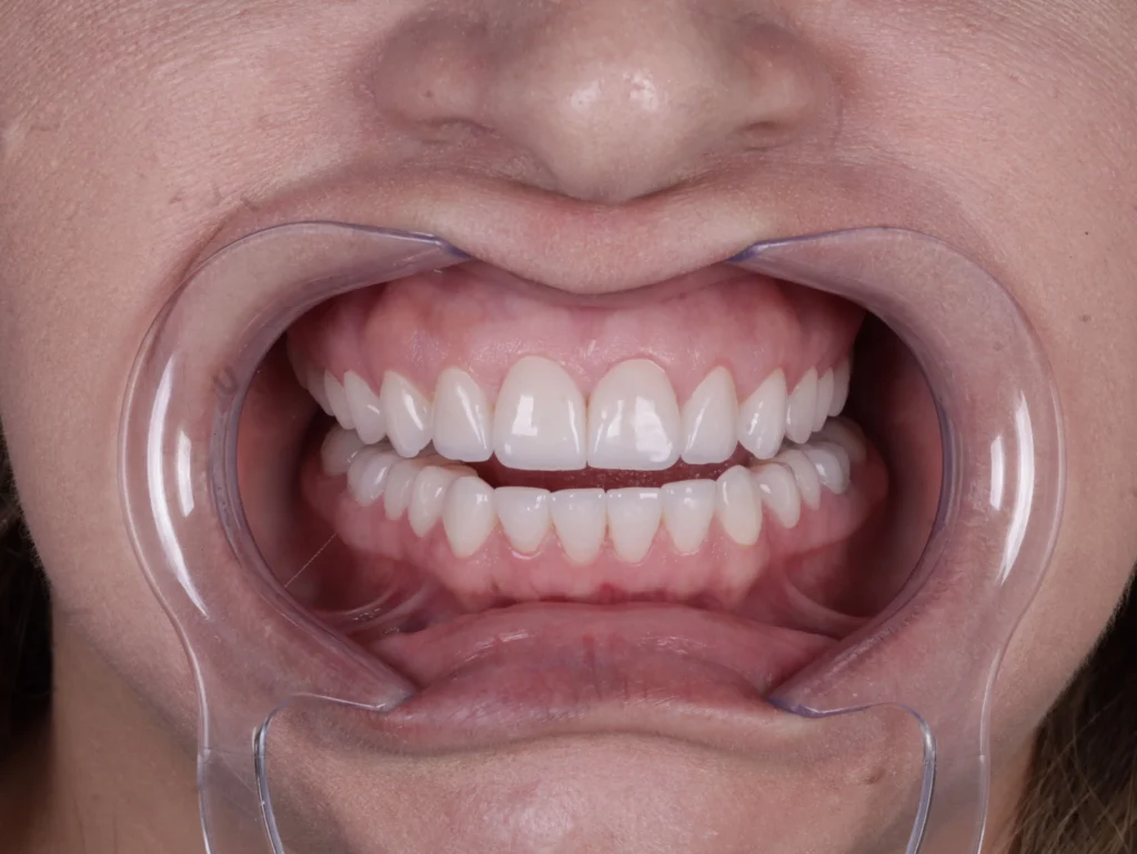 Lentes de contato dental: sorriso depois do tratamento, caso 01